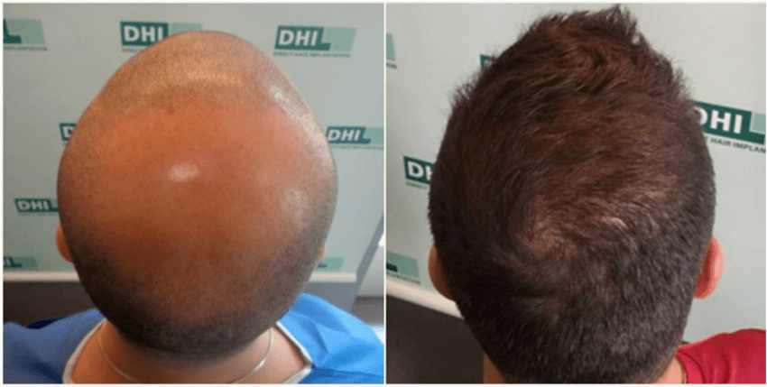 صور قبل وبعد عملية زراعة الشعر بتقنية DHI في تركيا