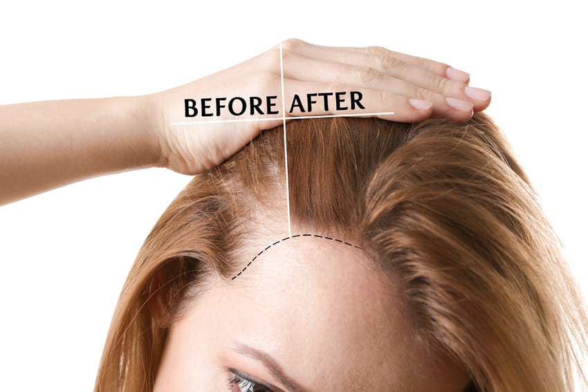 محاكاة زراعة الشعر للنساء