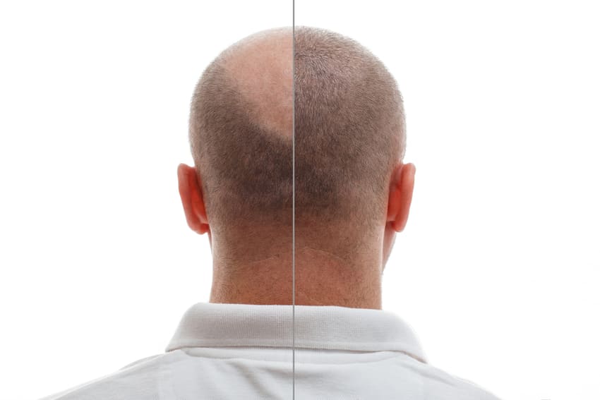 محاكاة الصور قبل وبعد زراعة الشعر