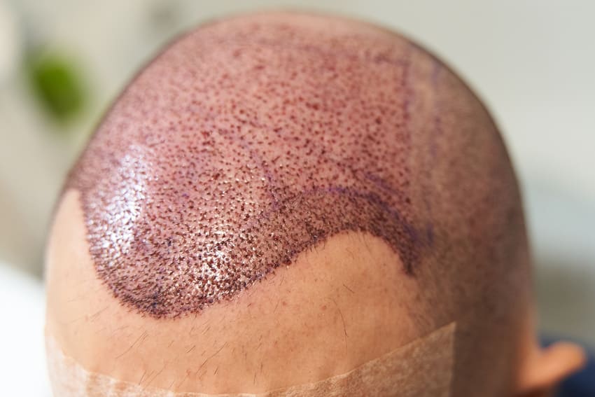 نتيجة الجمجمة بعد زراعة الشعر