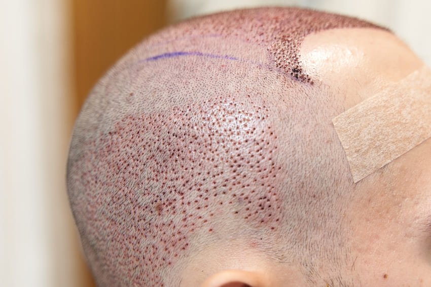 إزالة المنطقة المانحة وزراعتها في المنطقة المستقبلة