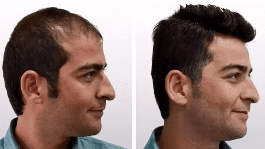 الصورة قبل وبعد زراعة الشعر في تركيا