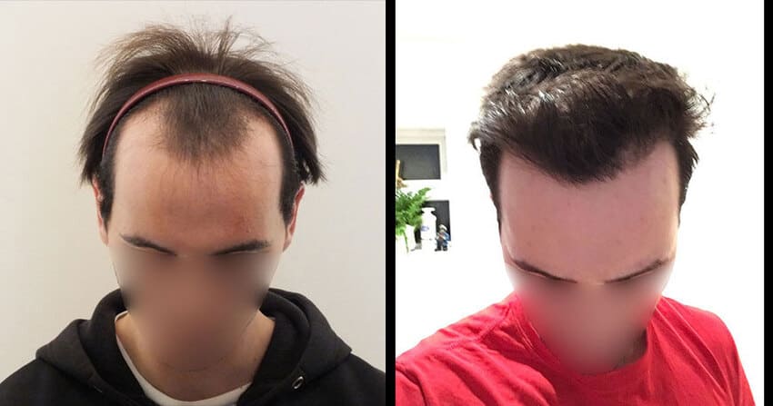صورة قبل وبعد عملية زراعة الشعر